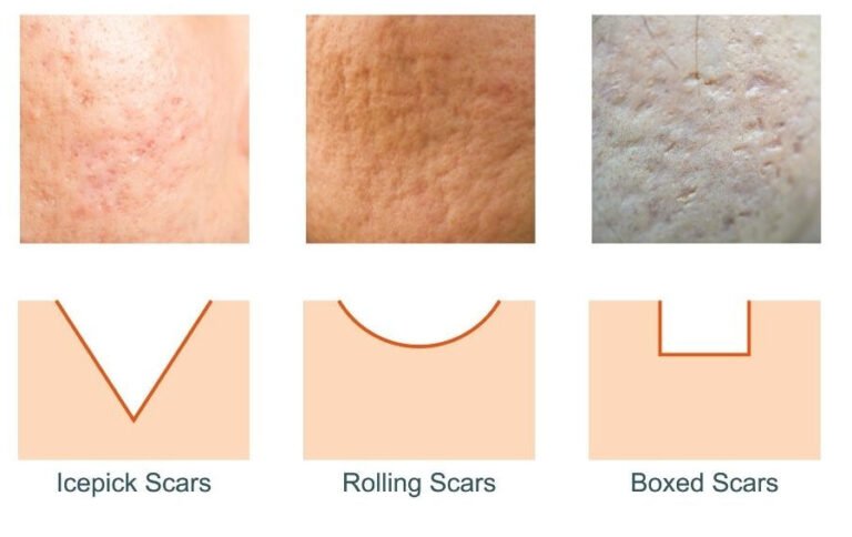 rejuran-healer-malaysia-acne-scars