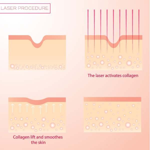 fractional-co2-laser