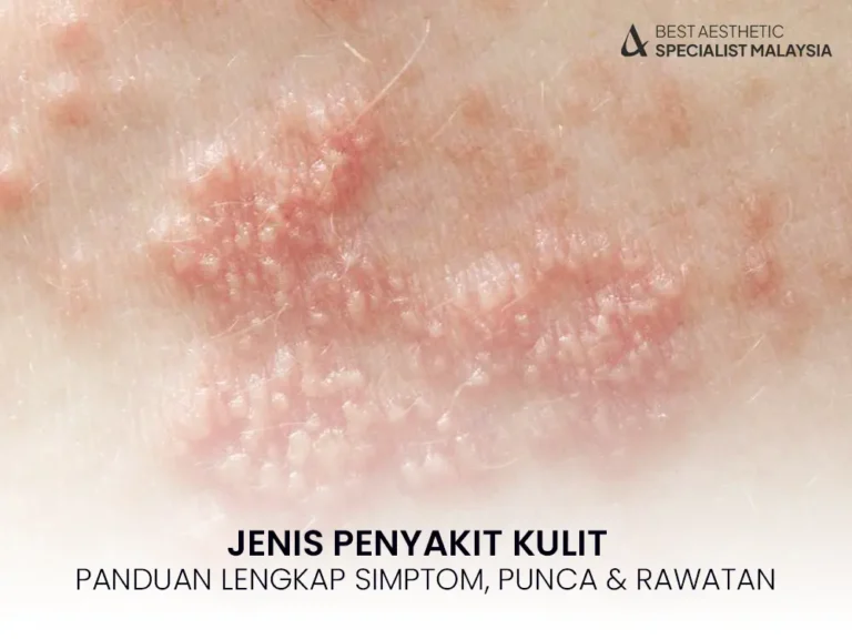 jenis-penyakit-kulit