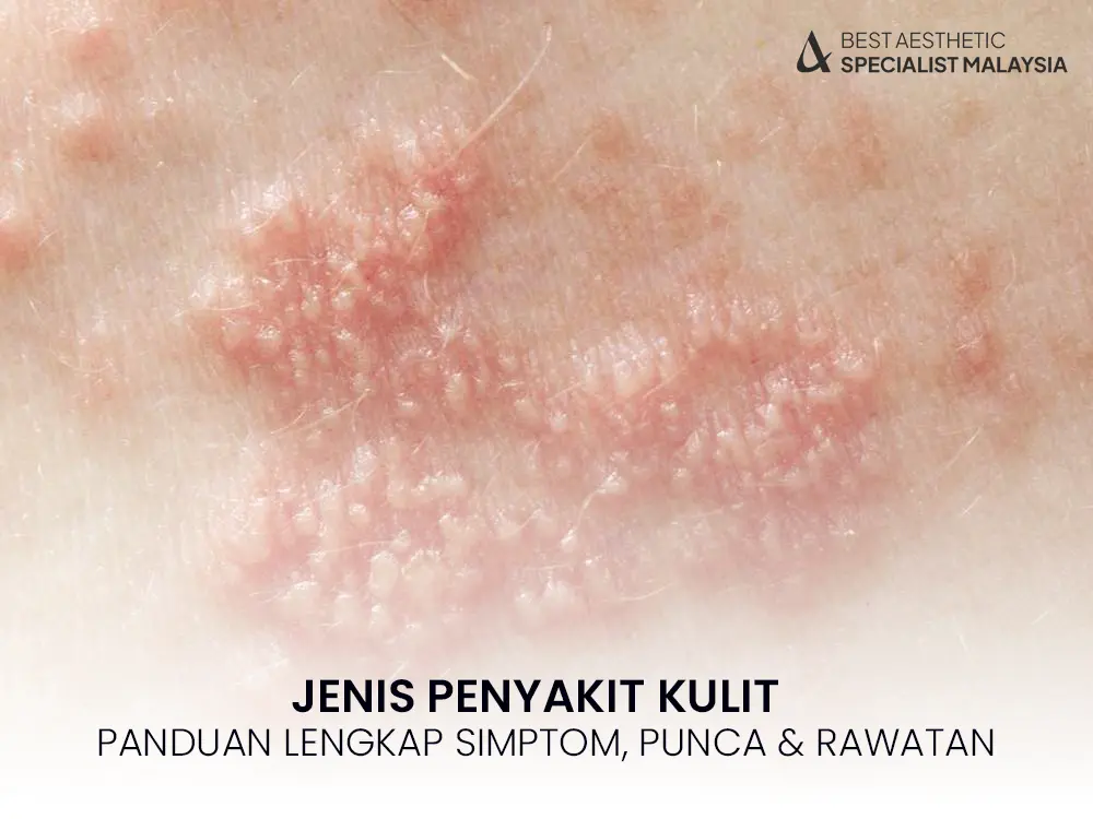 jenis-penyakit-kulit
