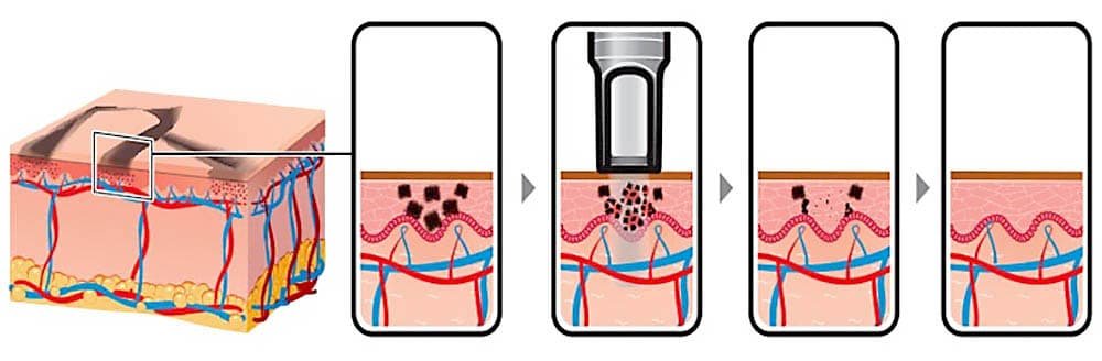pico-laser-treatment-kuala-lumpur