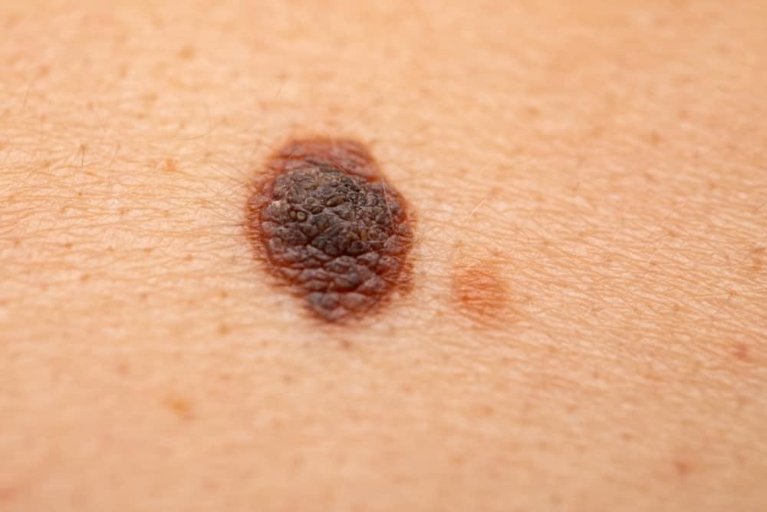 penyakit-kulit-melanoma