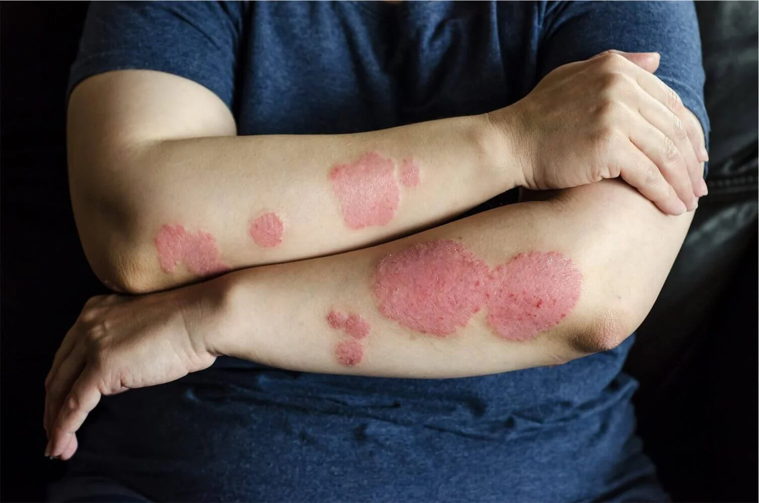 penyakit-kulit-Psoriasis