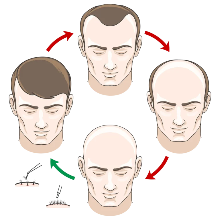 fue-hair-transplant-specialist-malaysia