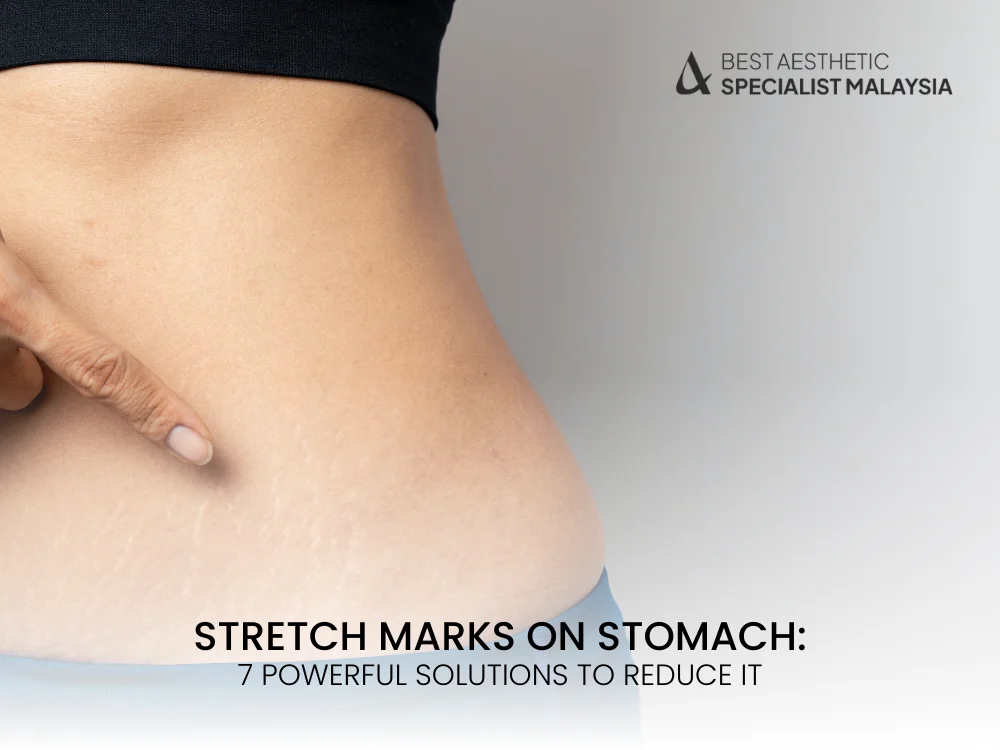 stretch-marks-on-stomach