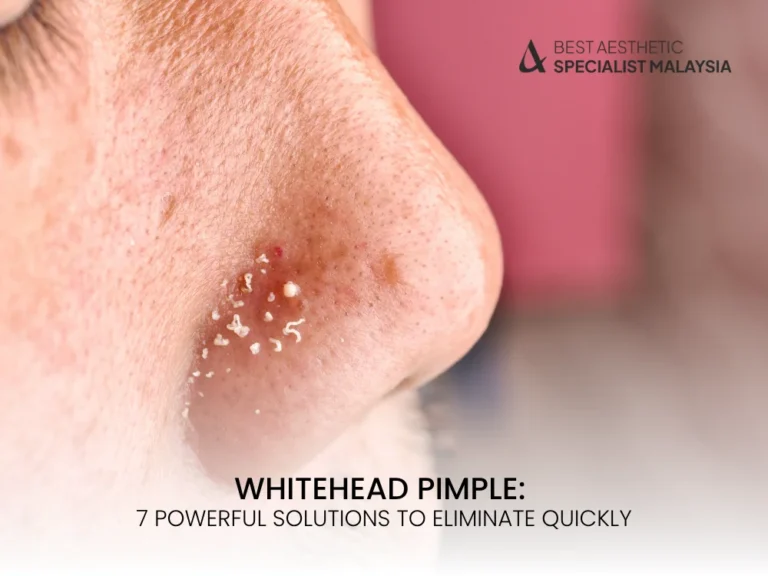 whitehead-pimple