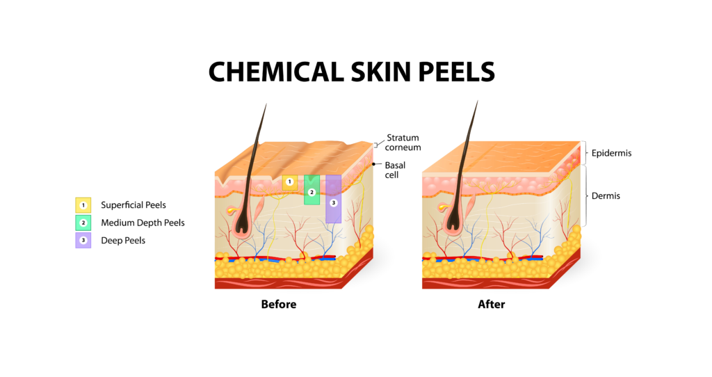 chemical-peel-benefits