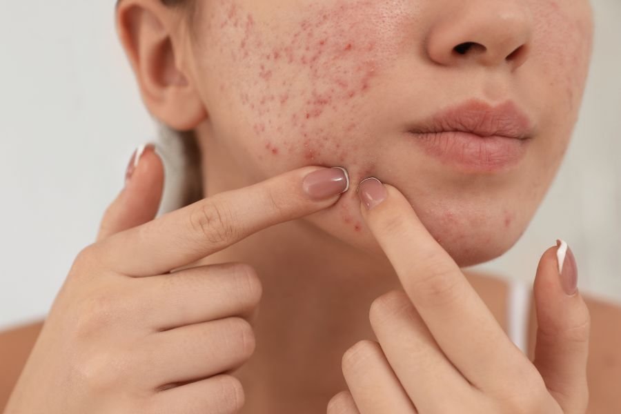muka-breakout-petua-tips-rawatan-berkesan