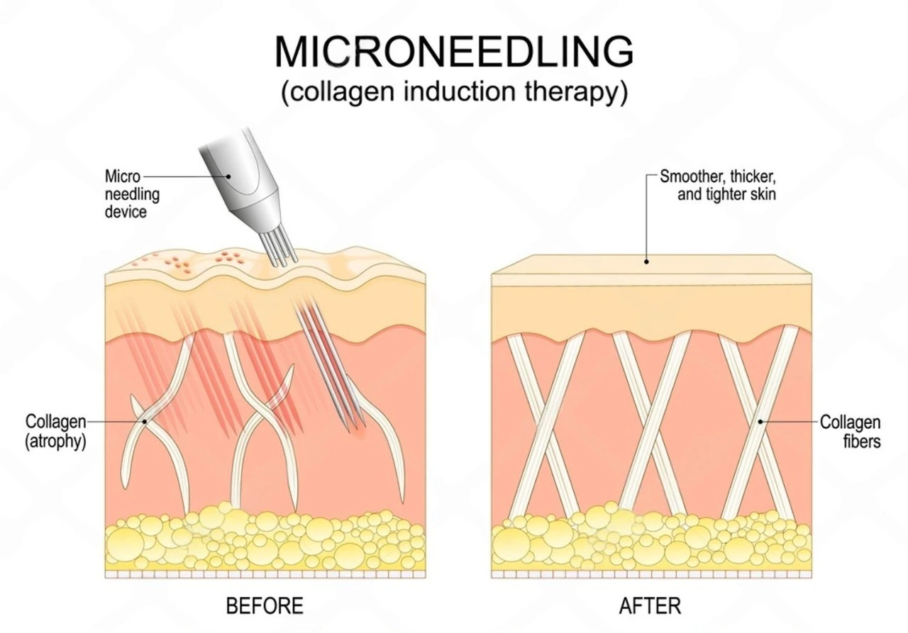 microneedling-treatment-malaysia-acne-scars