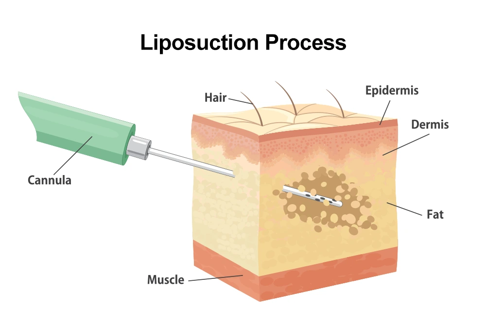 liposuction-procedure