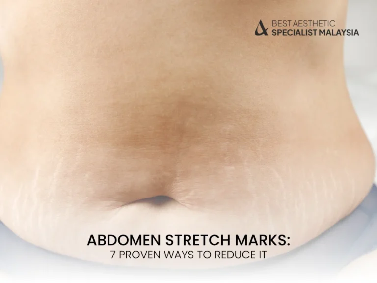 abdomen-stretch-marks