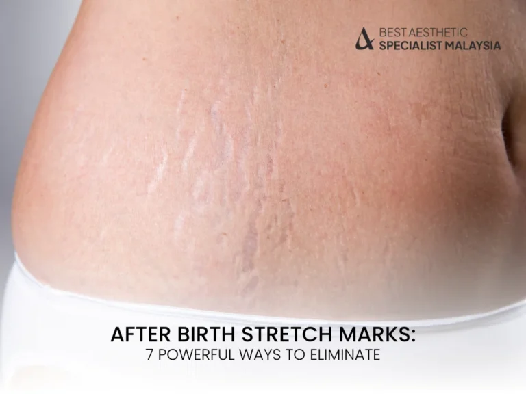 after-birth-stretch-marks
