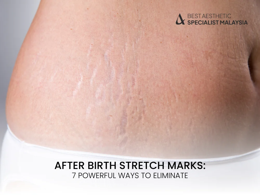 after-birth-stretch-marks