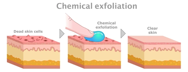 chemical-peels-chemical-peeling-solutions-acne-scars-malaysia