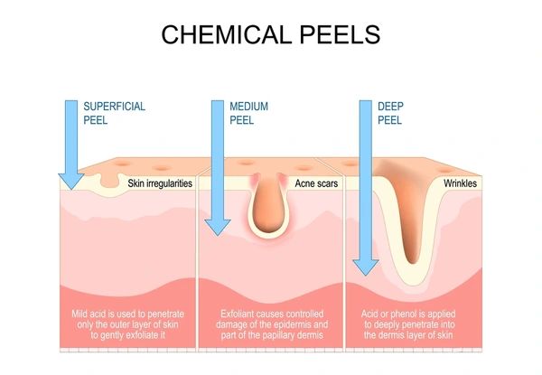 chemical-peels-chemical-peeling-solutions-acne-scars-malaysia