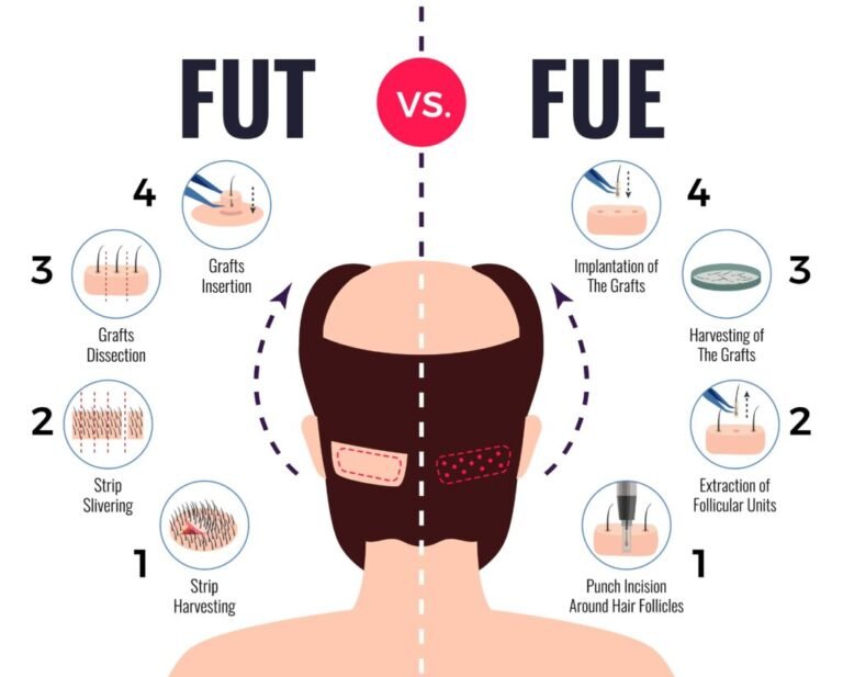 hair-transplant-fue-fut-comparison