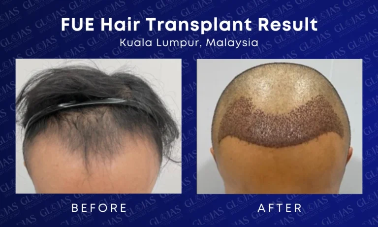 hair-transplant