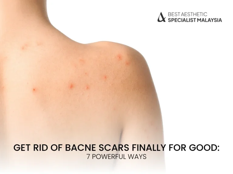 get-rid-of-bacne-scars