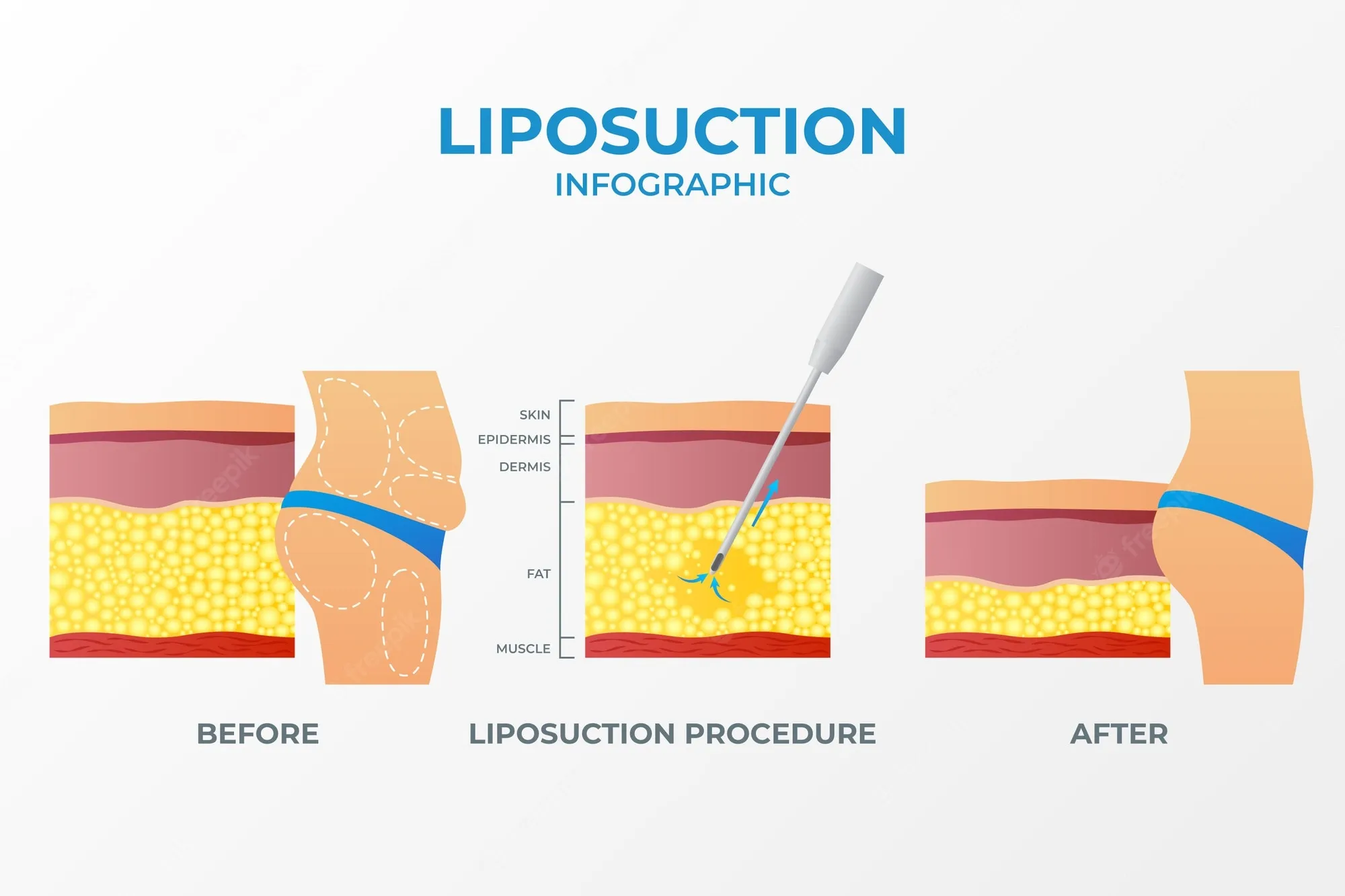 liposuction-surgery-malaysia-body-contouring