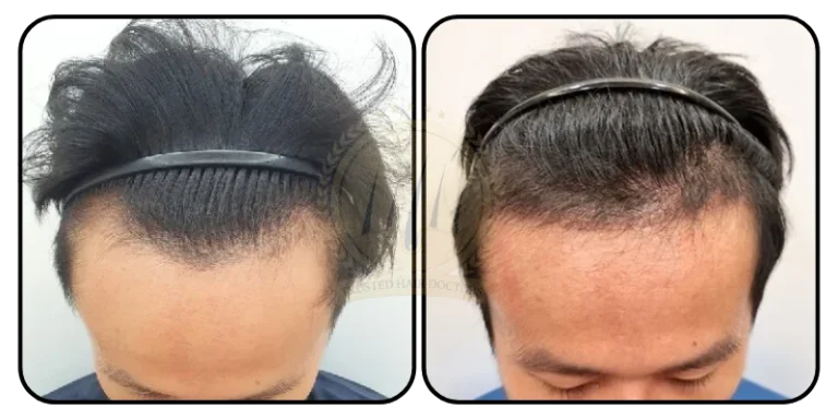 hair-transplant