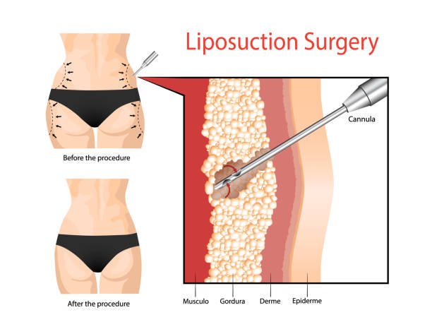 liposuction-weight-loss-fat-removal-clinic