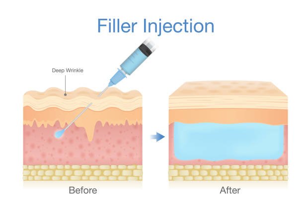 derma-fillers-injection