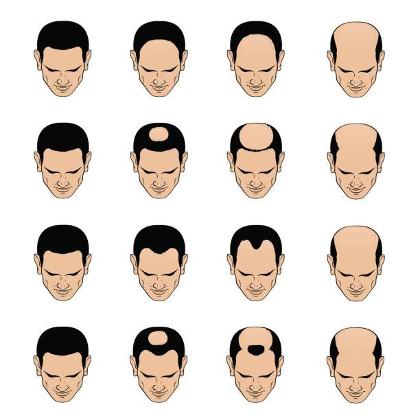 male-pattern-baldness-hair-transplant-surgery-clinic-malaysia