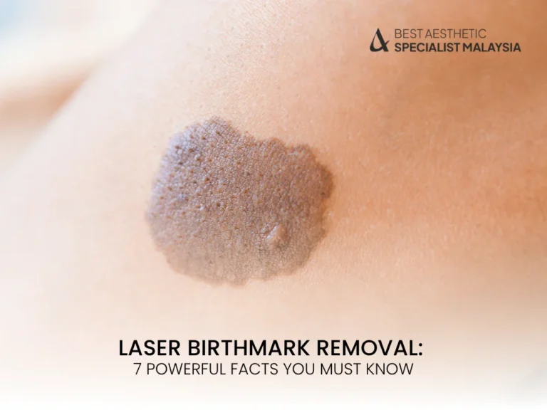 laser-birthmark-removal