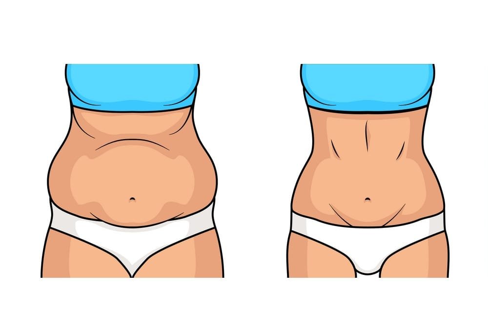 liposuction-benefits