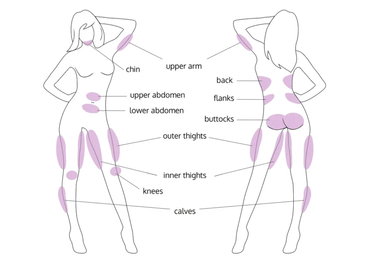 liposuction zones 1200