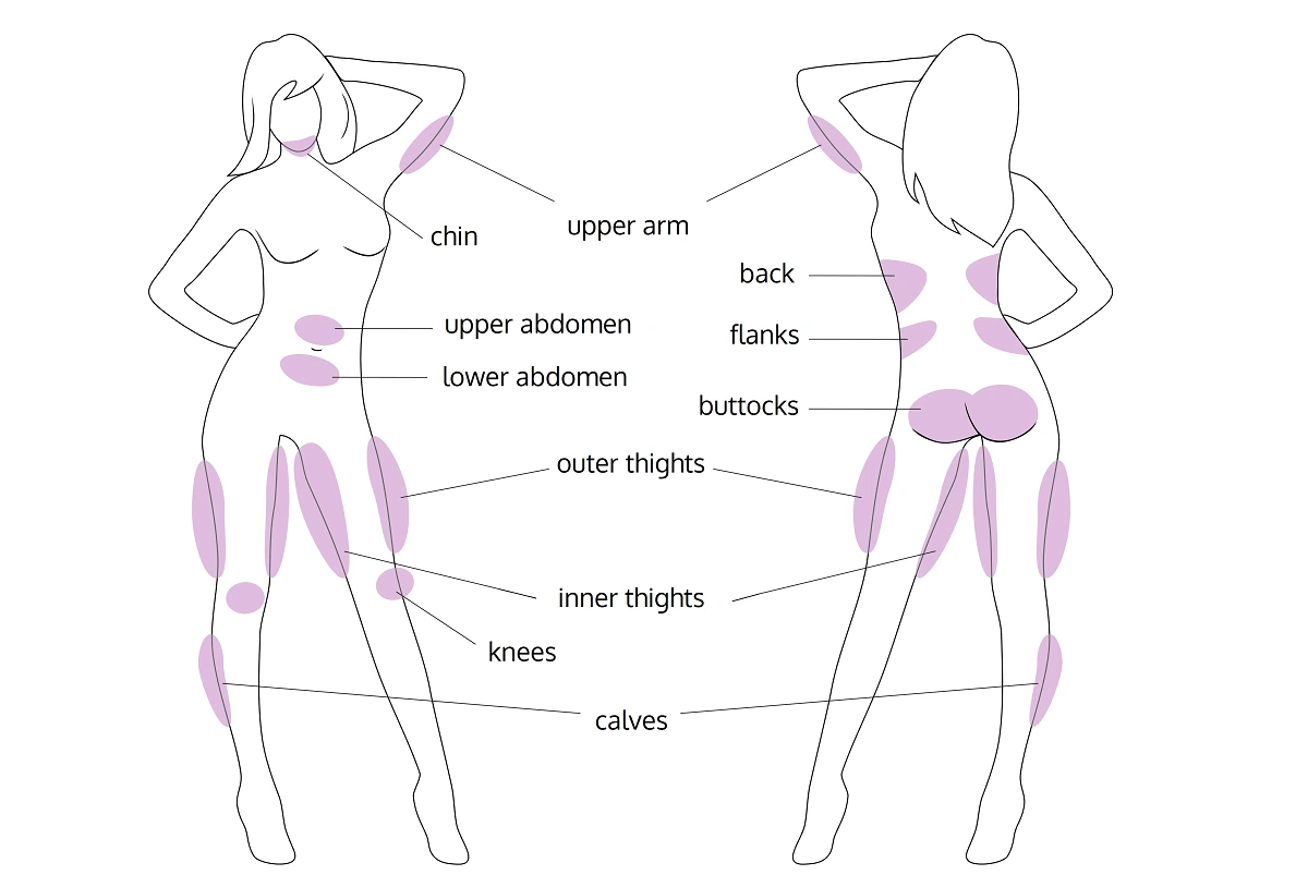 liposuction-areas-surgery-malaysia