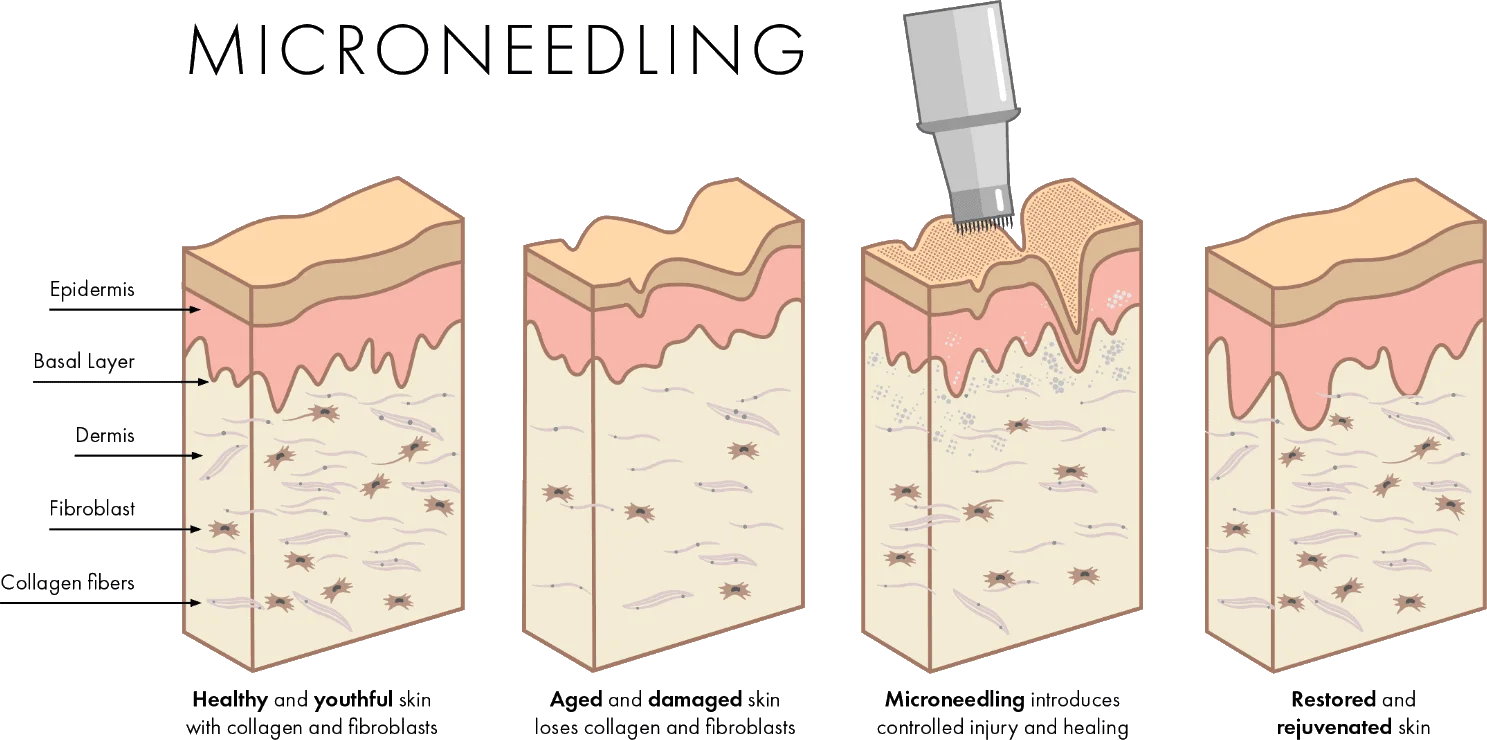 microneedling-with-prp-vs-rf-microneedling