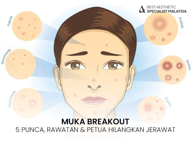 muka-breakout