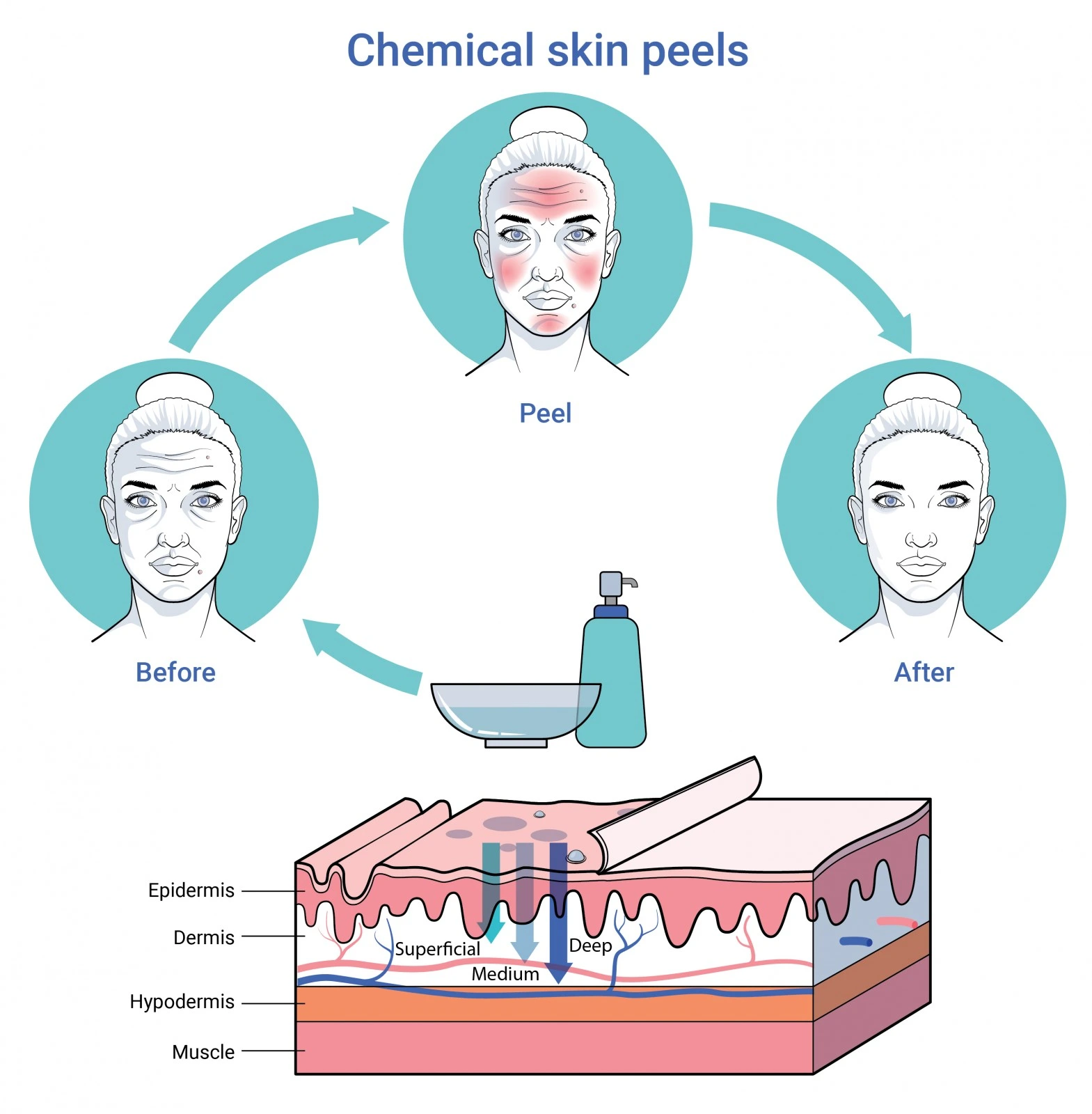 chemical-peel