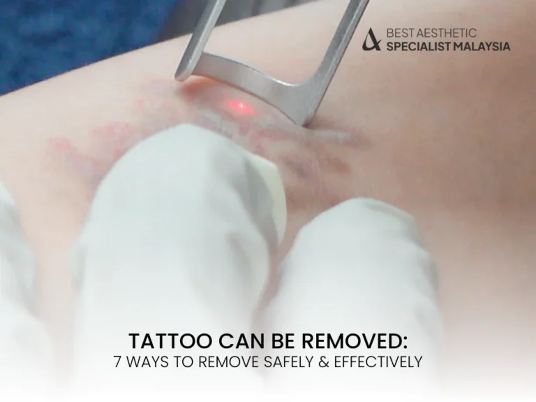 tattoo-can-be-removed