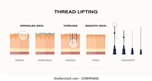 thread-lift