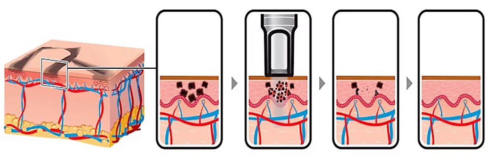 laser-dark-circle-treatment-pico-laser