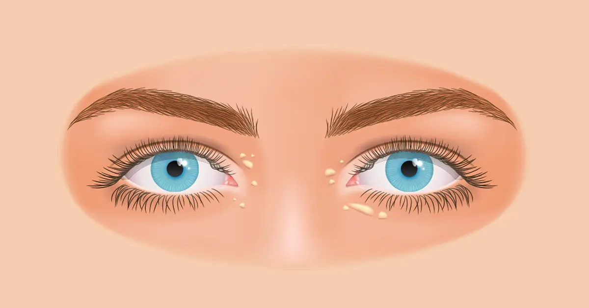 biji-kolesterol-Xanthelasma-Causes-Symptoms-and-Treatment