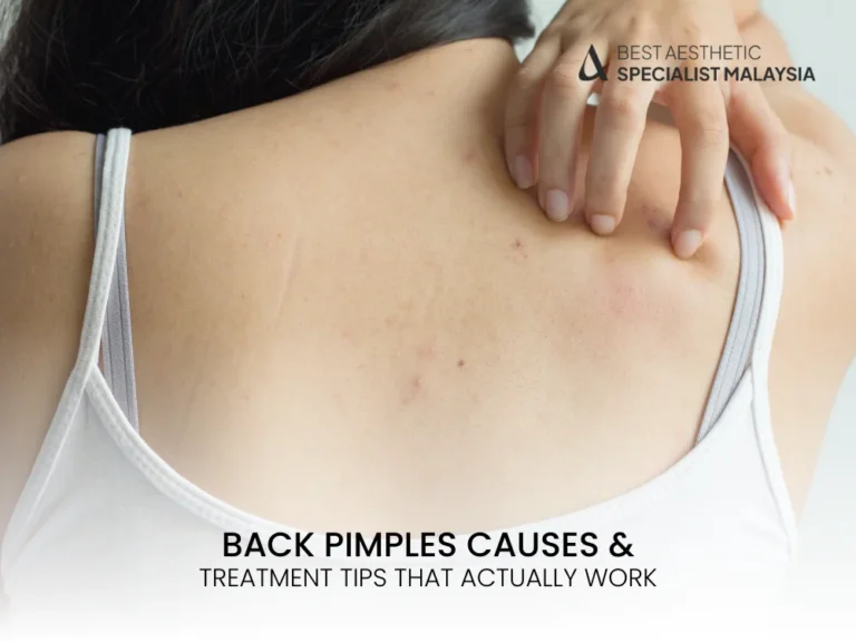 back-pimples-causes