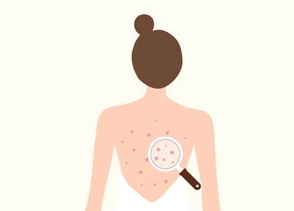 back-pimples-causes