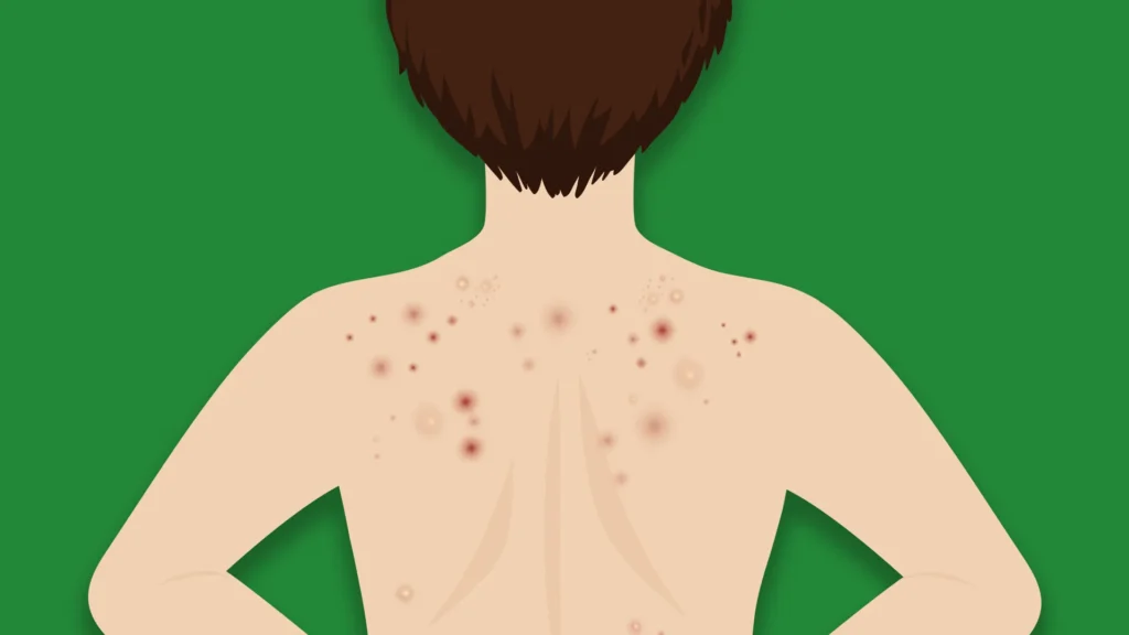 back-pimples-causes