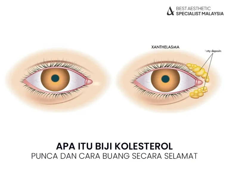 biji-kolesterol-malaysia-cara-rawat