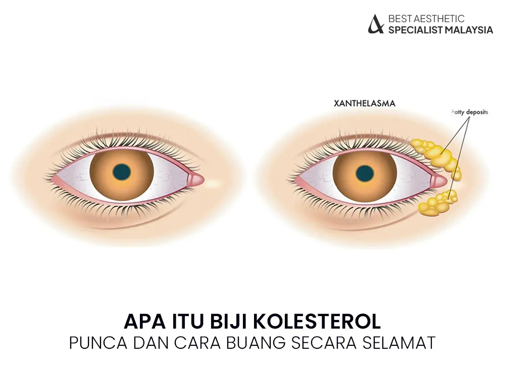 biji-kolesterol-malaysia-cara-rawat