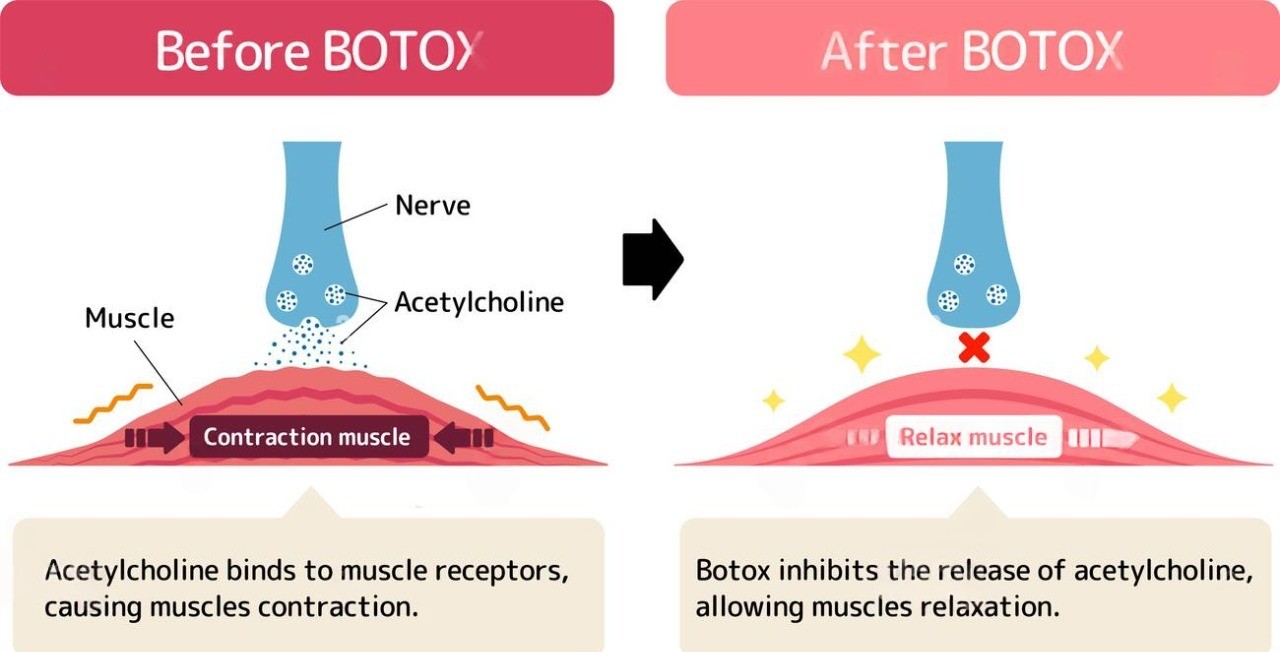 botox-injections-malaysia