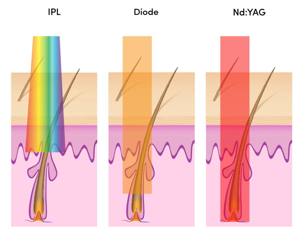 laser-hair-removal-malaysia-kuala-lumpur-trusted-clinic-diode-nd-yag