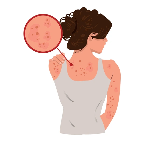 back-acne-malaysia-bacne-treatment