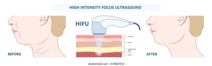 hifu-treatment-malaysia-before-after-skin-lifting