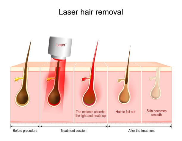 laser-hair-removal-malaysia