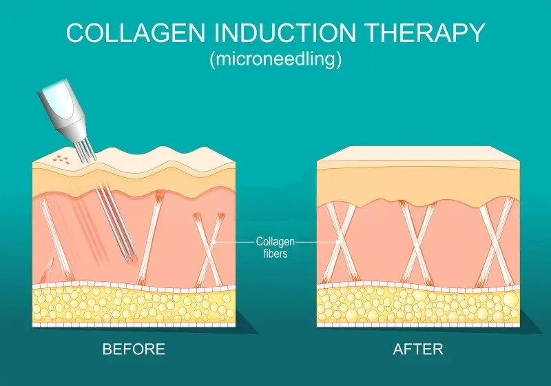 microneedling treatment