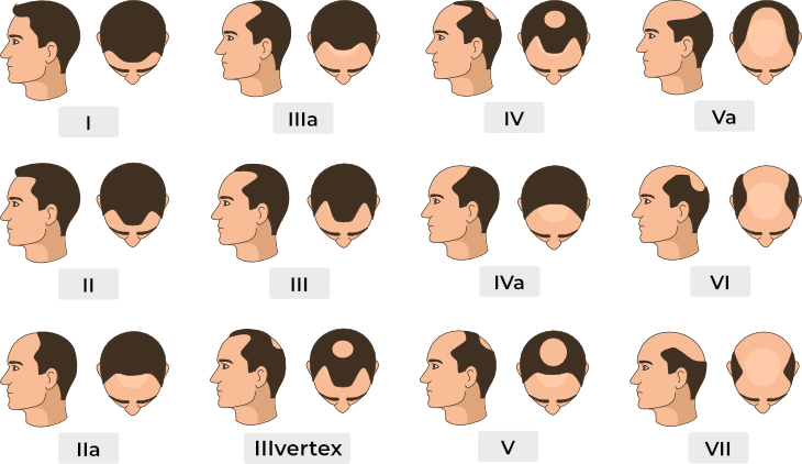 norwood-scale-hair-surgery-malaysia